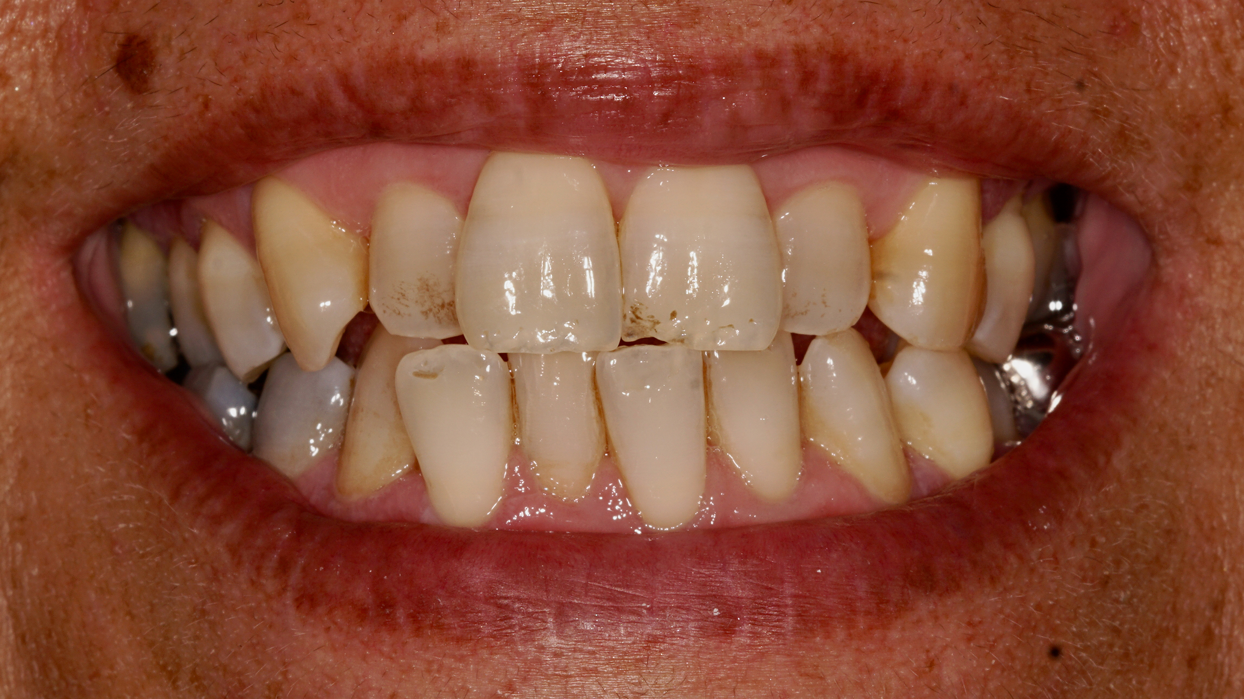 Invisalign – Before Invisalign - Before