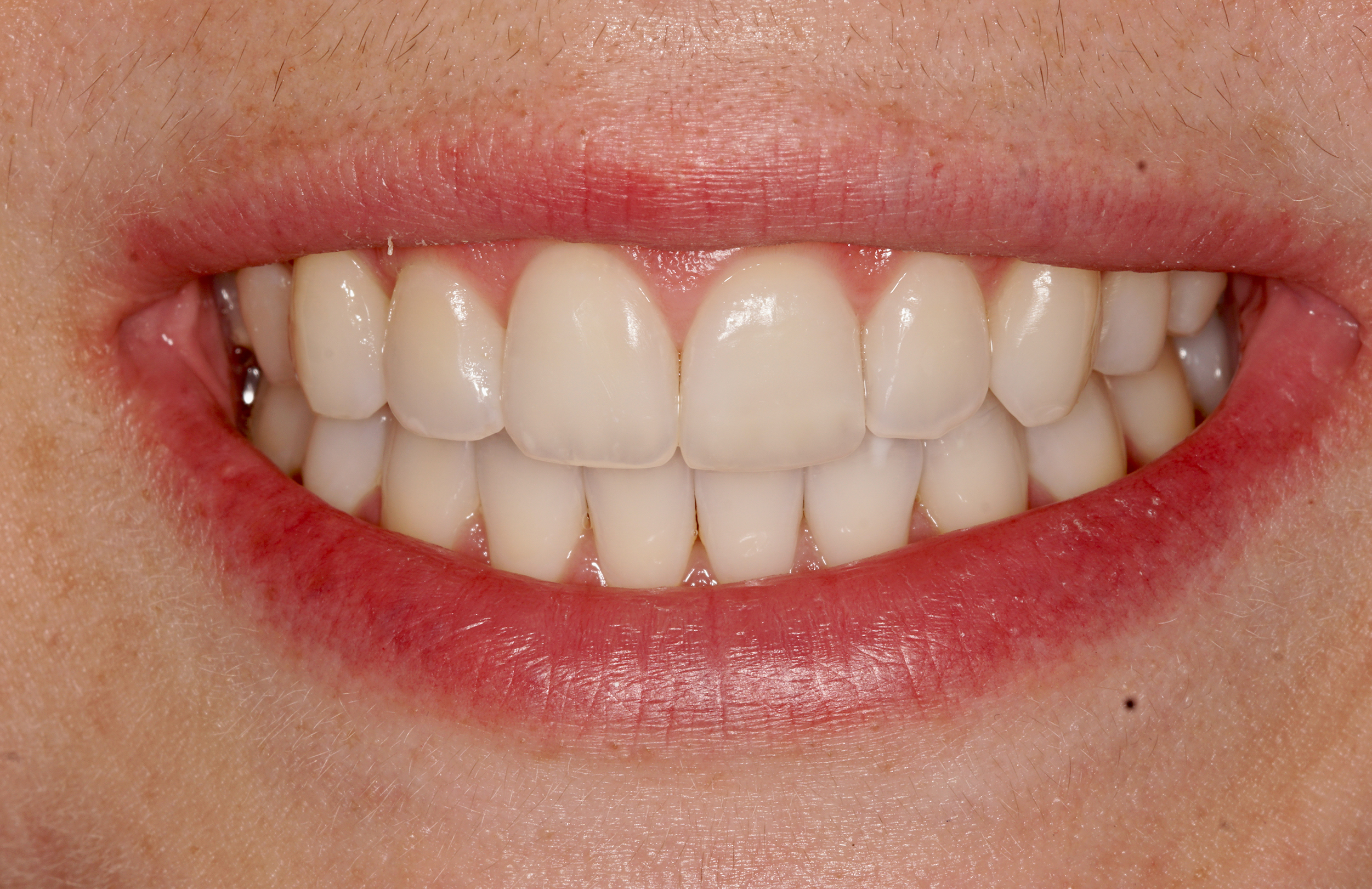 Invisalign – After Invisalign - After