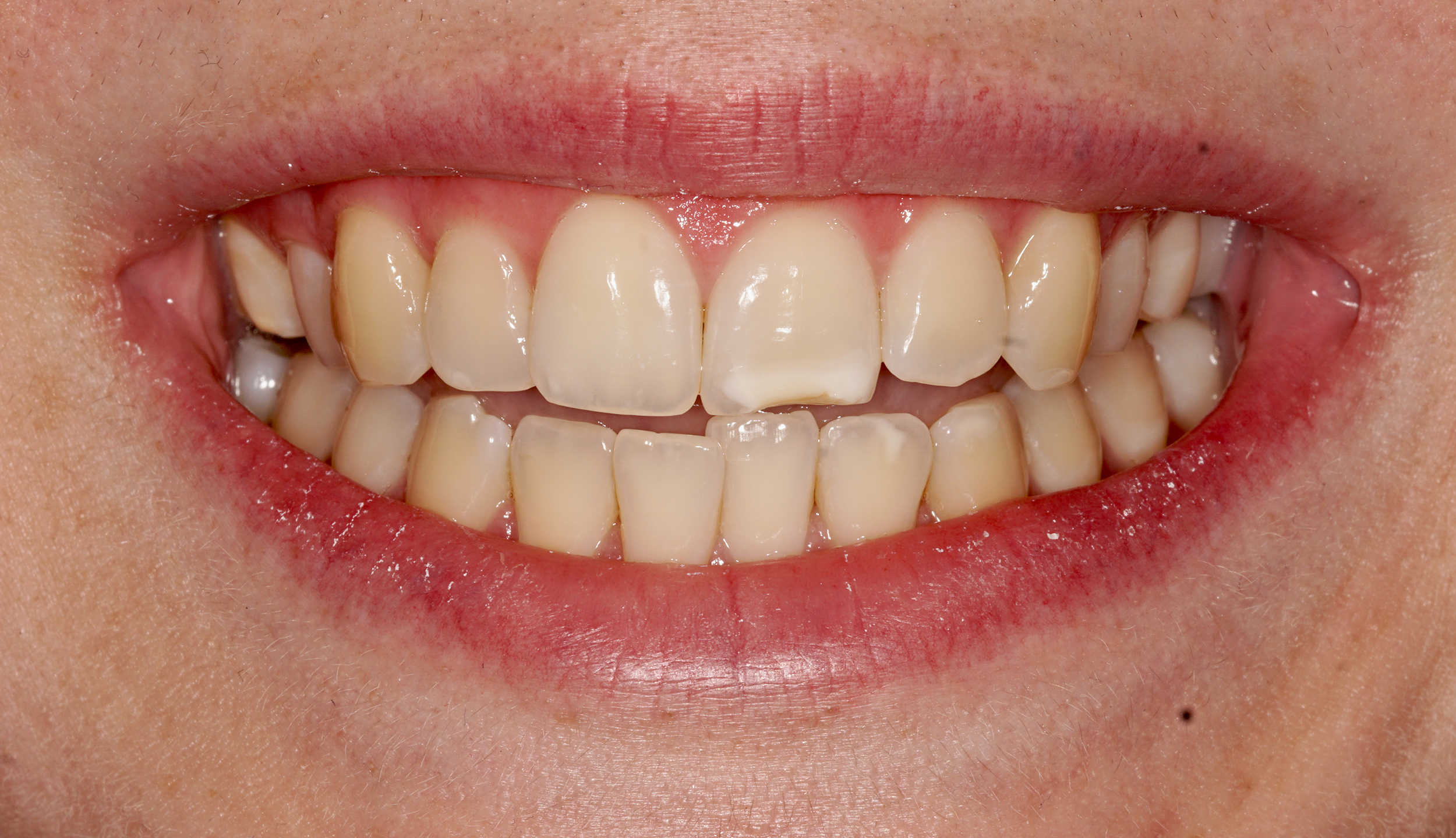 Invisalign – Before Invisalign - Before